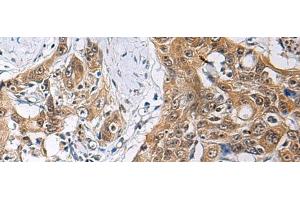 Immunohistochemistry of paraffin-embedded Human esophagus cancer tissue using THOC3 Polyclonal Antibody at dilution of 1:85(x200) (THO Complex 3 抗体)
