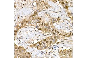 Immunohistochemistry of paraffin-embedded human breast cancer using ERK1/2 Rabbit mAb (ABIN7268620) at dilution of 1:100 (40x lens). (ERK1 抗体)