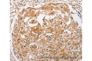 Immunohistochemistry of Human cervical cancer using PPP1CB Polyclonal Antibody at dilution of 1:30 (PPP1CB 抗体)