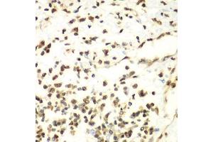 Immunohistochemistry of paraffin-embedded human liver cancer using HDAC2 antibody. (HDAC2 抗体  (C-Term))
