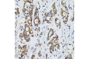 Immunohistochemistry of paraffin-embedded human colon carcinoma using SURF1 antibody (ABIN2560237) at dilution of 1:100 (40x lens). (SURF1 抗体)
