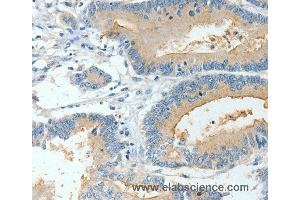 Immunohistochemistry of Human colon cancer using BAAT Polyclonal Antibody at dilution of 1:30 (BAAT 抗体)
