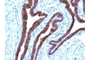 Formalin-fixed, paraffin-embedded human Ovarian Carcinoma stained with EpCAM Mouse Monoclonal Antibody (EGP40/1110). (EpCAM 抗体  (Cytoplasmic Domain))