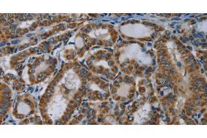 Immunohistochemistry of paraffin-embedded Human thyroid cancer using NDUFA5 Polyclonal Antibody at dilution of 1:60 (NDUFA5 抗体)