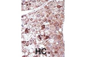 Formalin-fixed and paraffin-embedded human cancer tissue reacted with the primary antibody, which was peroxidase-conjugated to the secondary antibody, followed by DAB staining. (PCK1 抗体  (N-Term))