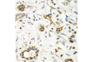 Immunohistochemistry of paraffin-embedded human liver cancer using NRBF2 antibody. (NRBF2 抗体  (AA 10-220))