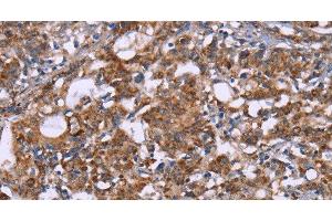 Immunohistochemistry of paraffin-embedded Human gastric cancer tissue using HSP10 Polyclonal Antibody at dilution 1:40 (HSPE1 抗体)