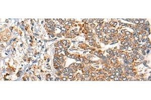 Immunohistochemistry of paraffin-embedded Human liver cancer tissue using EPHA6 Polyclonal Antibody at dilution of 1:40(x200) (EPH Receptor A6 抗体)