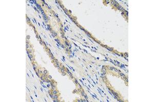 Immunohistochemistry of paraffin-embedded human prostate using RAD51C antibody (ABIN5974185) at dilution of 1/100 (40x lens). (RAD51C 抗体)