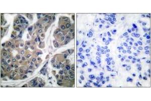 Immunohistochemistry analysis of paraffin-embedded human breast carcinoma, using eEF2 (Phospho-Thr56) Antibody. (EEF2 抗体  (pThr56))