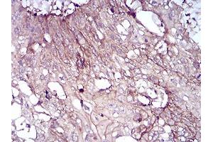 Immunohistochemical analysis of paraffin-embedded esophageal cancer tissues using CD6 mouse mAb with DAB staining. (CD6 抗体  (AA 18-199))