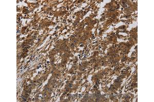 Immunohistochemistry of Human gastric cancer using ITGB7 Polyclonal Antibody at dilution of 1:40 (Integrin beta 7 抗体)