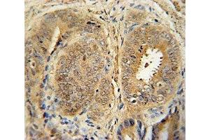 Anti-MDM2 antibody immunohistochemistry analysis in formalin fixed and paraffin embedded human prostate cancer. (MDM2 抗体  (AA 393-424))