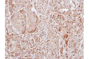 IHC-P Image Immunohistochemical analysis of paraffin-embedded A549 xenograft, using SOCS1, antibody at 1:100 dilution. (SOCS1 抗体  (C-Term))