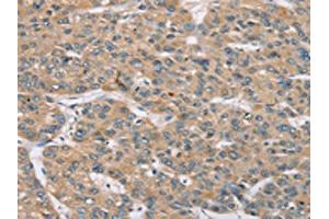 The image on the left is immunohistochemistry of paraffin-embedded Human liver cancer tissue using ABIN7192155(RBM38 Antibody) at dilution 1/35, on the right is treated with synthetic peptide. (RBM38 抗体)