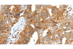Immunohistochemistry of paraffin-embedded Human ovarian cancer tissue using SCT Polyclonal Antibody at dilution 1:40 (Secretin 抗体)