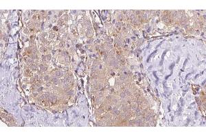 ABIN6273335 at 1/100 staining Human thyroid cancer tissue by IHC-P. (TRPC4AP 抗体  (N-Term))