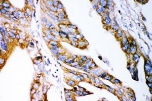 IHC-P: Claudin 2 antibody testing of human intestinal cancer tissue (Claudin 2 抗体  (AA 38-230))