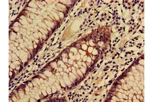 Immunohistochemistry of paraffin-embedded human colon cancer using ABIN7171891 at dilution of 1:100 (Tspan-8 抗体  (AA 110-205))