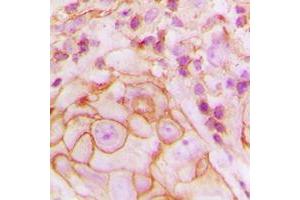 Immunohistochemical analysis of GPR105 staining in human breast cancer formalin fixed paraffin embedded tissue section. (P2RY14 抗体  (Center))
