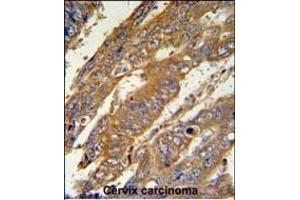 N3 Antibody (C-term) (ABIN651149 and ABIN2840100) IHC analysis in formalin fixed and raffin embedded human cervix carcinoma followed by peroxidase conjugation of the secondary antibody and DAB staining. (PAN3 抗体  (C-Term))