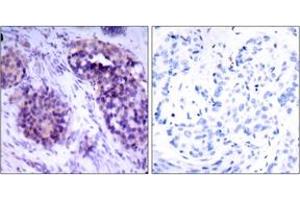 Immunohistochemistry analysis of paraffin-embedded human breast carcinoma tissue, using BCL-XL (Ab-62) Antibody. (BCL2L1 抗体  (AA 28-77))