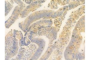 ABIN7095361 and ABIN7099418 at 1/100 staining human colon carcinoma by IHC-P.