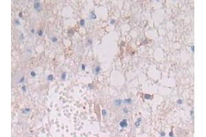 Detection of HLA-DRB1 in Human Glioma Tissue using Polyclonal Antibody to HLA Class II Histocompatibility Antigen, DRB1 Beta Chain (HLA-DRB1)