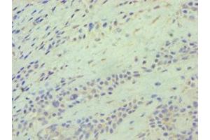 Immunohistochemistry of paraffin-embedded human breast cancer using ABIN7145117 at dilution of 1:100 (ATG9A 抗体  (AA 180-290))