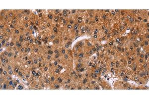 Immunohistochemistry of paraffin-embedded Human liver cancer using ING2 Polyclonal Antibody at dilution of 1:40 (ING2 抗体)