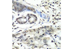 Immunohistochemistry of paraffin-embedded human gastric cancer using HIF1AN antibody (ABIN5973179) at dilution of 1/100 (40x lens). (HIF1AN 抗体)