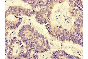 Immunohistochemistry of paraffin-embedded human colon cancer using ABIN7169300 at dilution of 1: 100 (PGAM5 抗体  (AA 30-223))