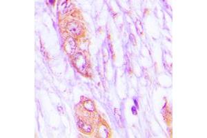 Immunohistochemical analysis of MELK staining in human lung cancer formalin fixed paraffin embedded tissue section. (MELK 抗体  (Center))
