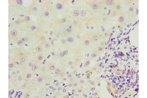 Immunohistochemistry of paraffin-embedded human liver cancer using ABIN7151406 at dilution of 1:100 (EFCAB12 抗体  (AA 1-200))