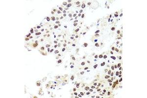 Immunohistochemistry of paraffin-embedded human lung cancer using HIRA antibody.