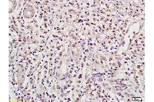 Formalin-fixed and paraffin embedded human gastric carcinoma labeled with Anti RBPJK RBP-J Polyclonal Antibody, unconjugated (ABIN872972) at 1:200 followed by incubation with conjugated secondary antibody and DAB staining (RBPJ 抗体  (AA 101-200))