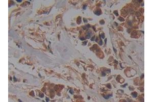 DAB staining on IHC-P; Samples: Human Breast cancer Tissue (NUP37 抗体  (AA 34-279))