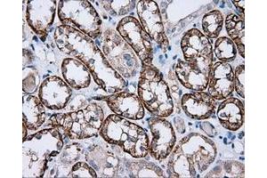 Immunohistochemical staining of paraffin-embedded Carcinoma of liver tissue using anti-RC201933 mouse monoclonal antibody. (PIM2 抗体)