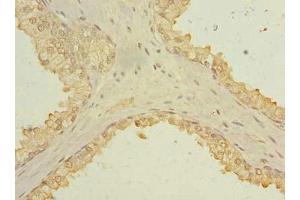 Immunohistochemistry of paraffin-embedded human prostate cancer using ABIN7173631 at dilution of 1:100 (TSACC/C1orf182 抗体  (AA 1-125))