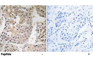 Immunohistochemistry analysis of paraffin-embedded human breast carcinoma tissue, using MRPL41 polyclonal antibody . (MRPL41 抗体)