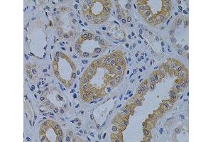 Immunohistochemistry of paraffin-embedded Human kidney cancer using MVP Polyclonal Antibody at dilution of 1:200 (40x lens). (MVP 抗体)
