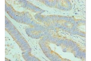 Immunohistochemistry of paraffin-embedded human colon cancer using ABIN7149525 at dilution of 1:100 (DCAF7 抗体  (AA 1-342))