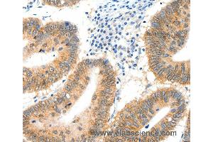 Immunohistochemistry of Human cervical cancer using SIPA1 Polyclonal Antibody at dilution of 1:40 (SIPA1 抗体)
