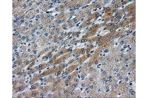Immunohistochemical staining of paraffin-embedded Carcinoma of liver tissue using anti-LIPG mouse monoclonal antibody. (LIPG 抗体)