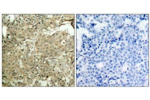 Immunohistochemical analysis of paraffin-embedded human breast carcinoma tissue using cofilin(Phospho-Ser3) Antibody(left) or the same antibody preincubated with blocking peptide(right). (Cofilin 抗体  (pSer3))