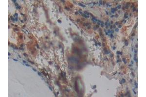 Detection of SNCG in Human Thyroid Tissue using Polyclonal Antibody to Gamma-synuclein (SNCG) (SNCG 抗体  (AA 1-121))