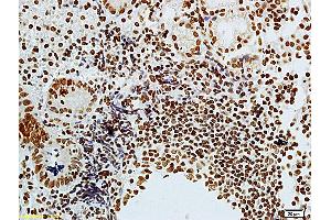 Formalin-fixed and paraffin embedded human colon carcinoma labeled with Anti-phospho-CDKN1A/P21 (Thr57) Polyclonal Antibody, Unconjugated (ABIN756877) at 1:200 followed by conjugation to the secondary antibody (p21 抗体  (pThr57))