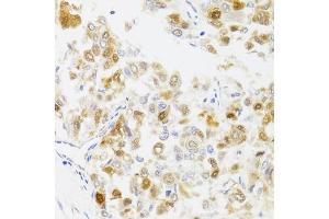 Immunohistochemistry of paraffin-embedded human liver cancer using MYO5A antibody. (MYO5A 抗体)