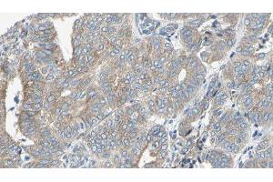 ABIN6276702 at 1/100 staining Human cervical cancer tissue by IHC-P. (NQO1 抗体  (C-Term))