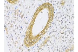 Immunohistochemistry of paraffin-embedded human adenomyosis using RAB27A Antibody (ABIN5970998) at dilution of 1/100 (40x lens). (RAB27A 抗体)